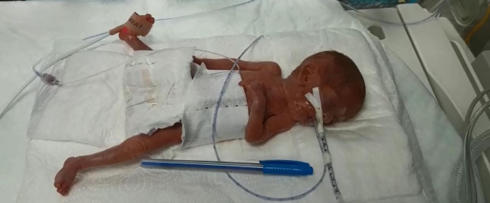 “Türkiye’de bir ilk, 285 gram doğan Elçin bebek hayata tutundu”